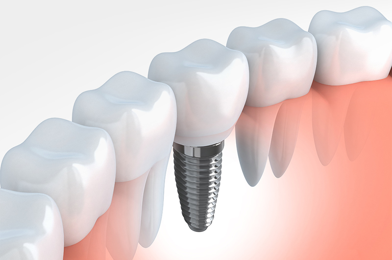 Replace missing teeth with dental implants in Bristol